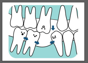 implant