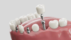 implant-dentaire