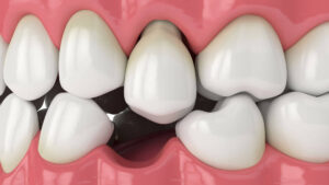 implants-unitaires