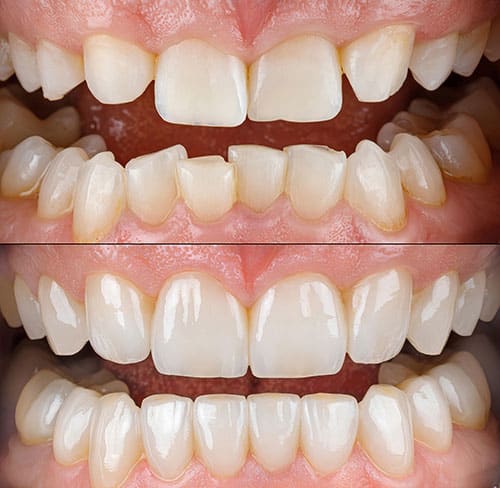 Avant et après un traitement d'orthodontie