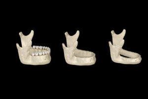 prothese-sur-implant