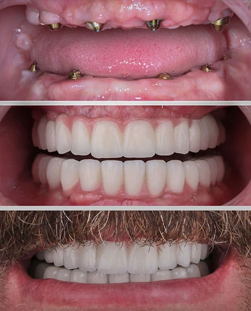 Prothèse-sur-implants