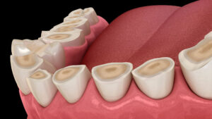 plaque-occlusale-rehabilitation-complete